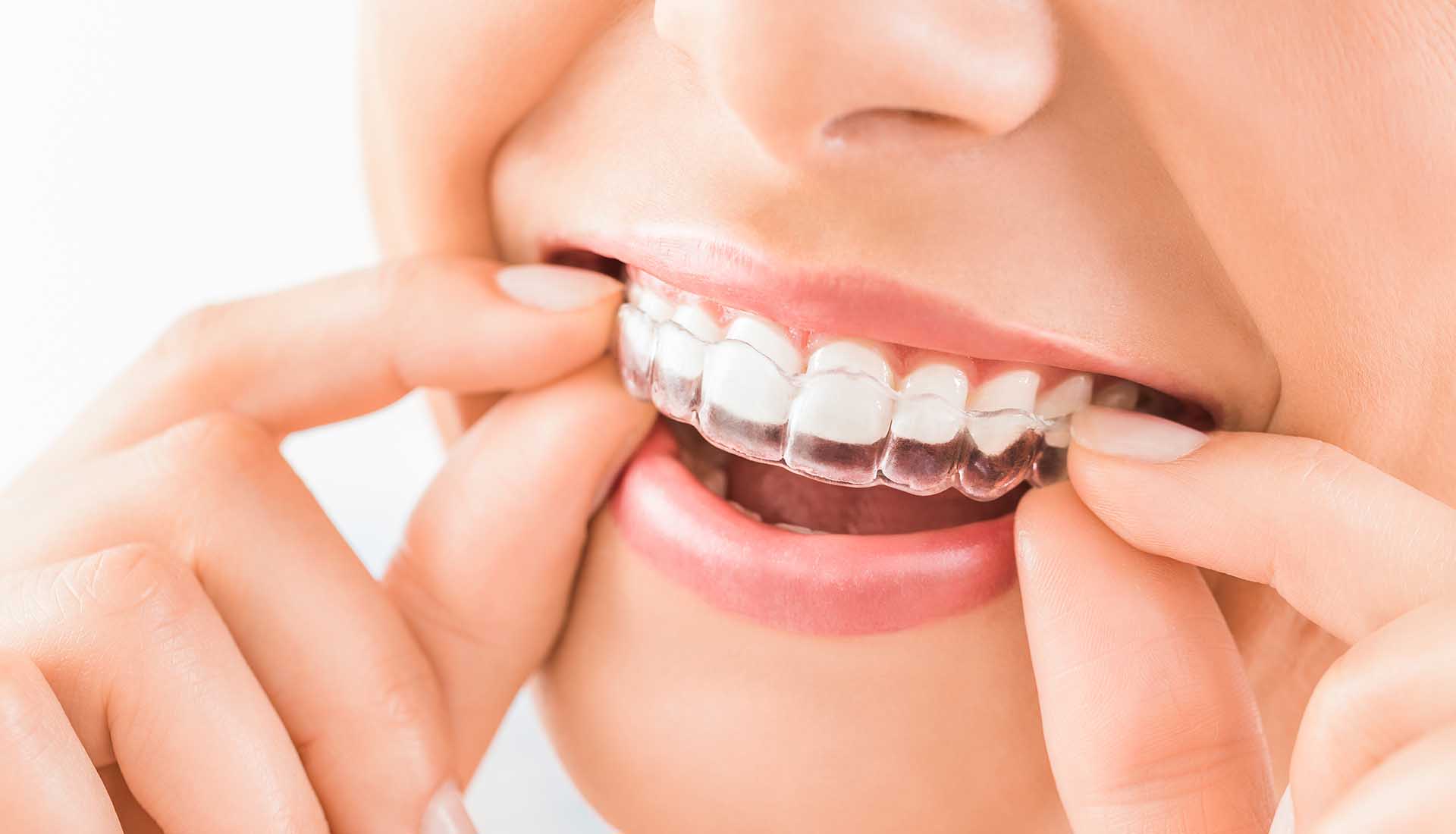 What To Expect Before And After Treatment: Clear Invisible Braces